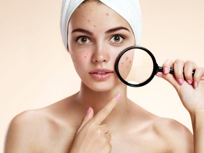 The Easiest Method To Eliminate Acne Scarring – Natural & Cosmetic Treatments