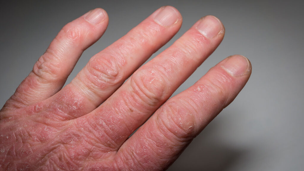 Dealing With Psoriatic Arthritis