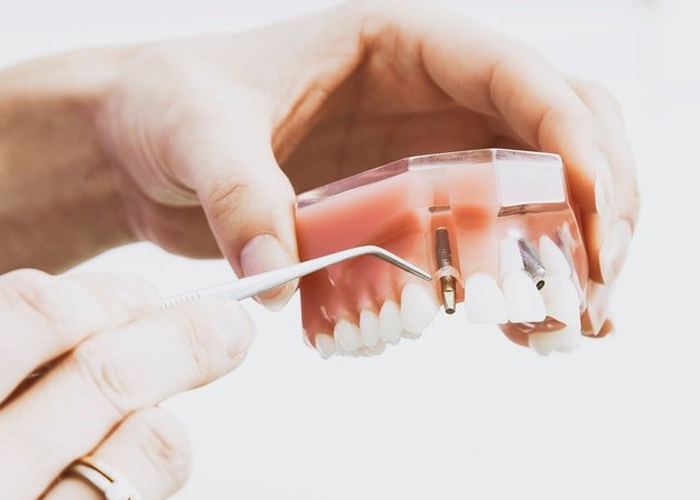 Dental Implant Procedure: What to Expect During Consultation