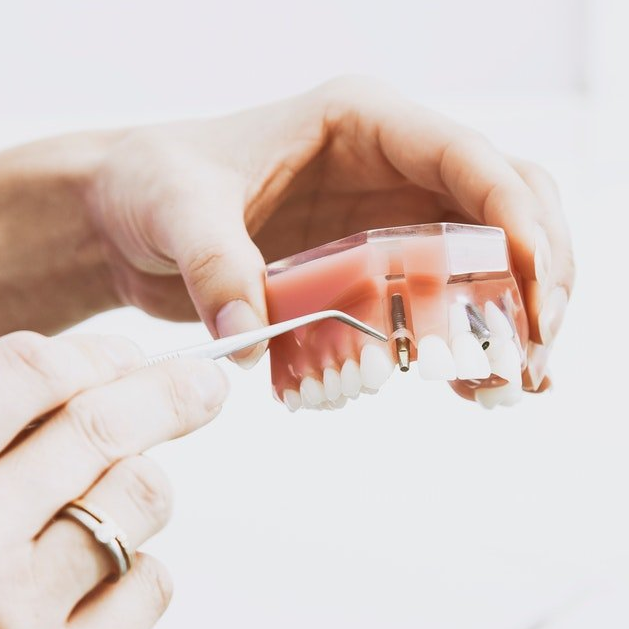 Dental Implant Procedure: What to Expect During Consultation