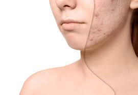 Acne Scar Treatment: What Are Your Options?