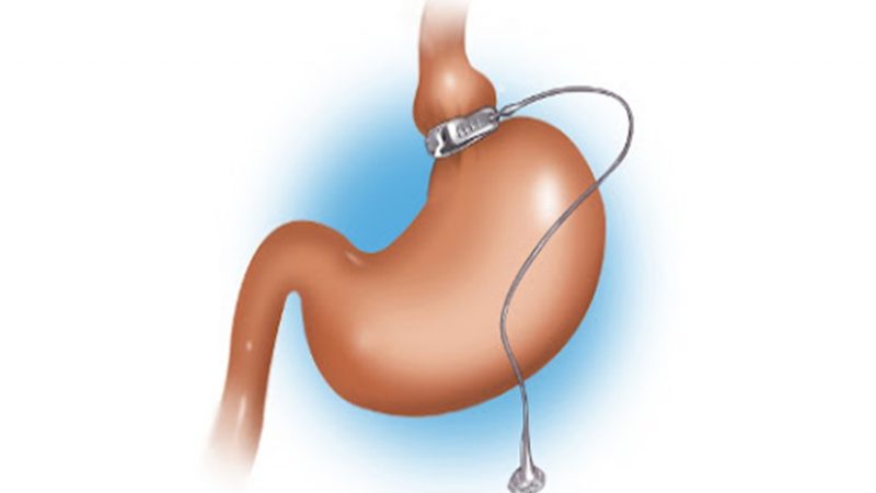 Preparing for a gastric banding surgery