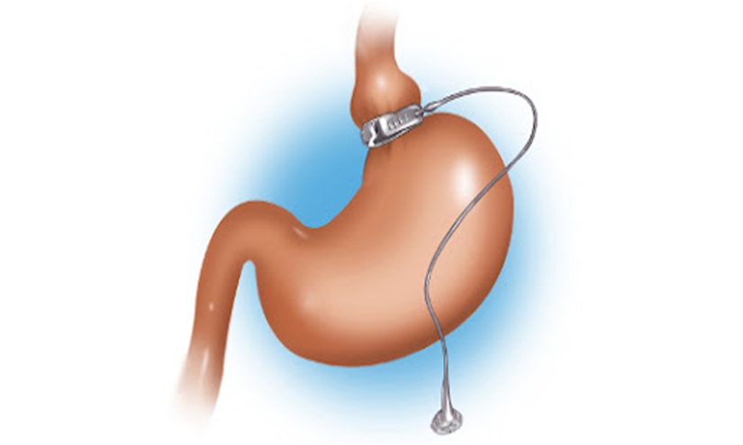 Preparing for a gastric banding surgery