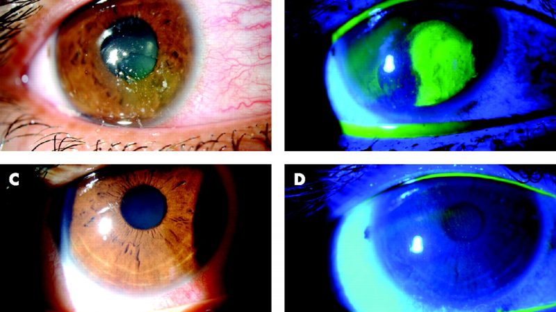 Surgical approach for recurrent corneal erosions