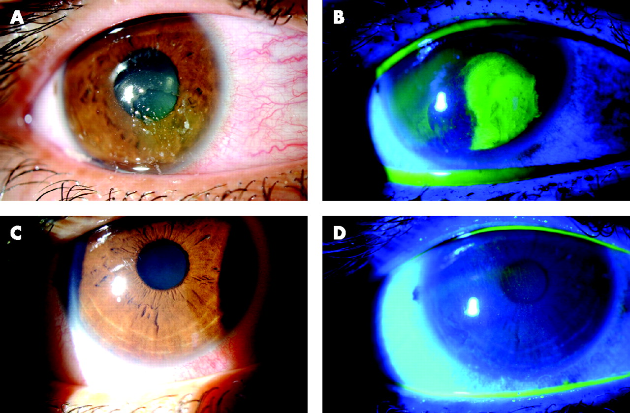 Surgical approach for recurrent corneal erosions