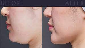 Can You Remove Double Chin without Surgery?