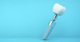 Dental Implants: When is Bone Grafting Required?