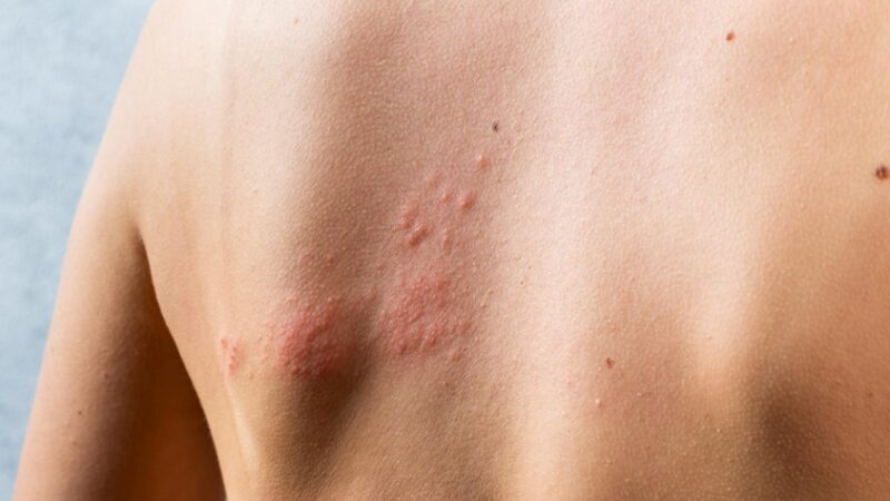 Truth About Shingles