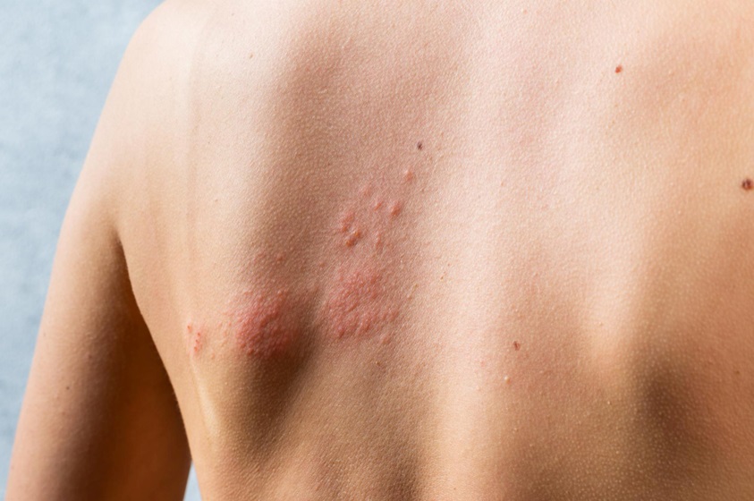 Truth About Shingles