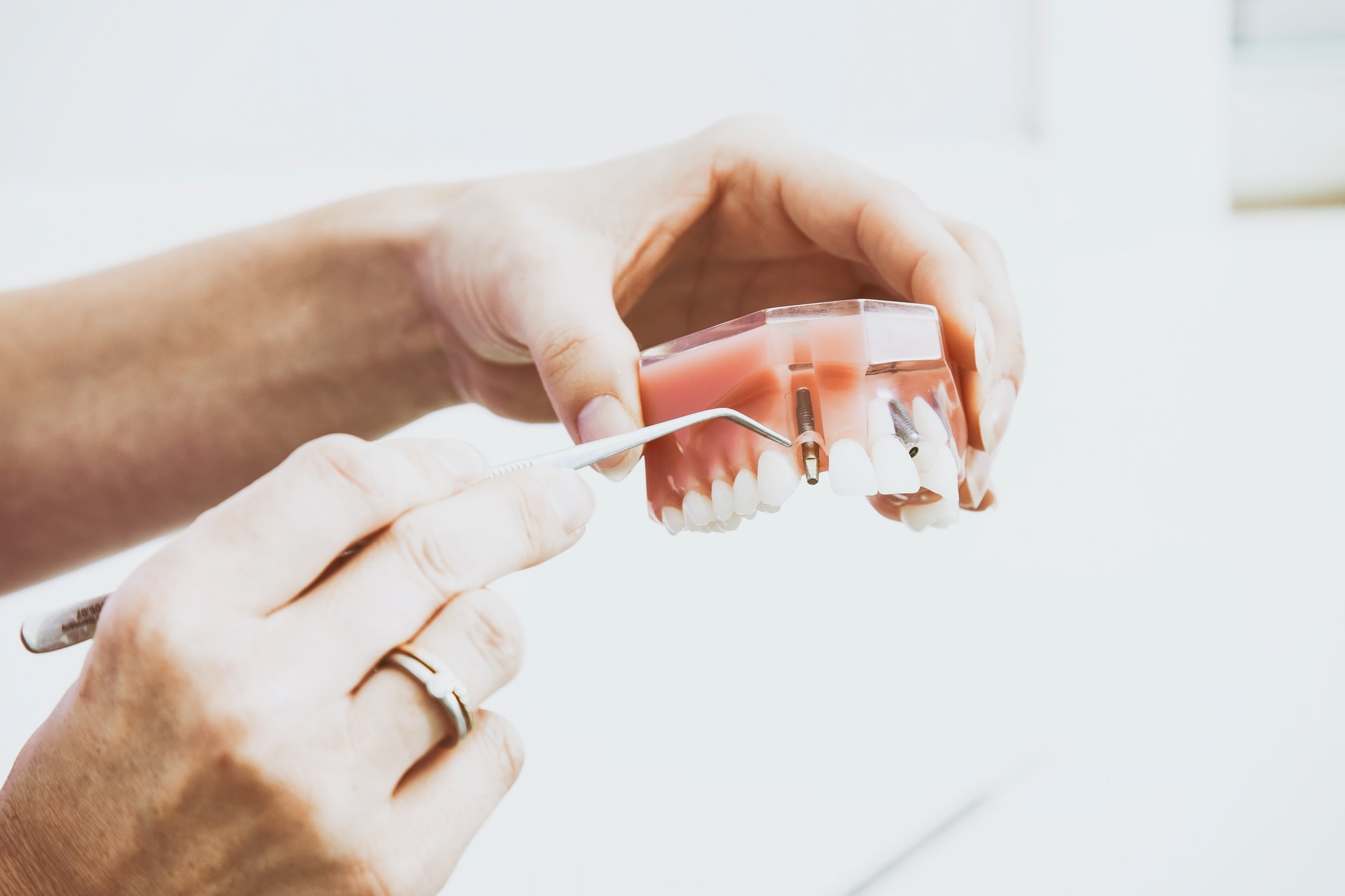Are Mini Dental Implants Reliable?