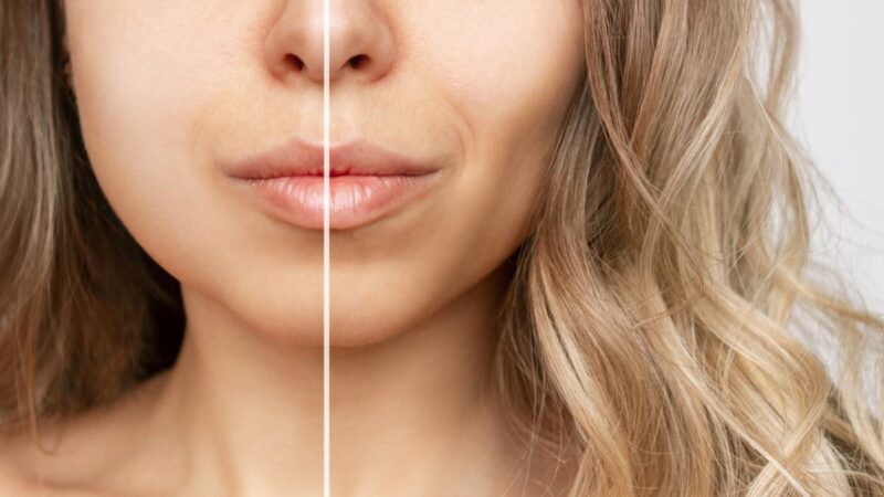 Buccal Fat Pad Removal: Everything You Need To Know
