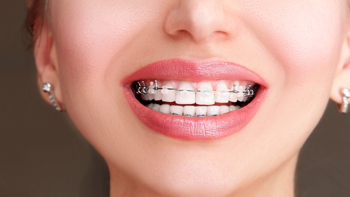 Achieve A Beautiful Smile With Enhanced Comfort With Damon Braces