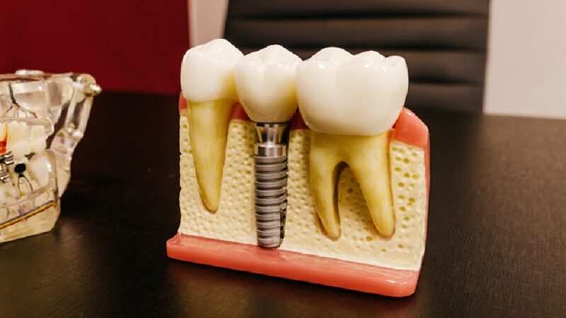 Replacing missing teeth with dental implants