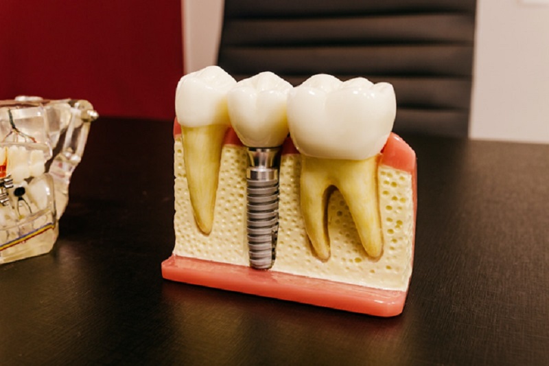 Replacing missing teeth with dental implants