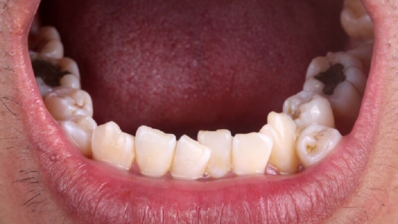 Invisalign Macleod for correcting crooked teeth