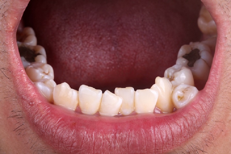 Invisalign Macleod for correcting crooked teeth