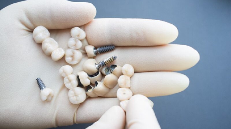 How dental implants can help with tooth loss