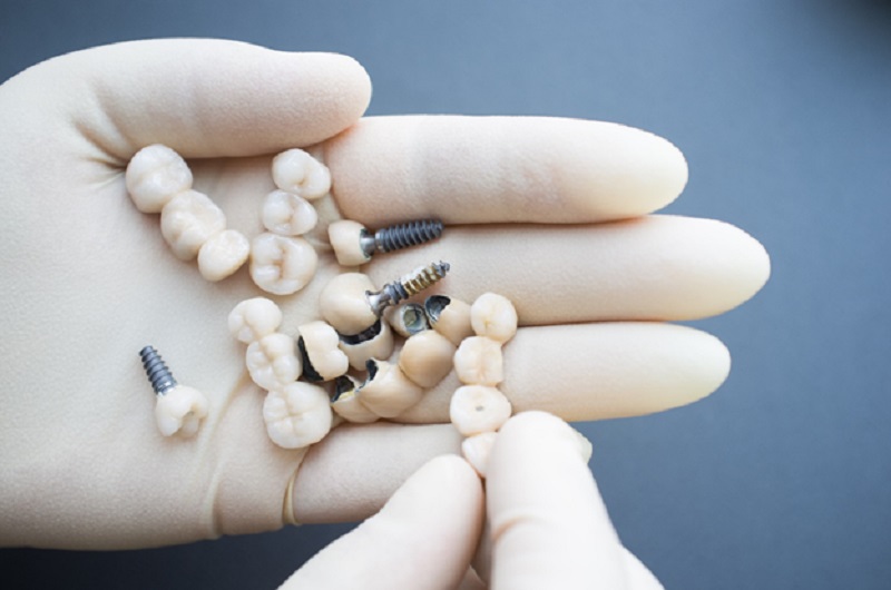 How dental implants can help with tooth loss
