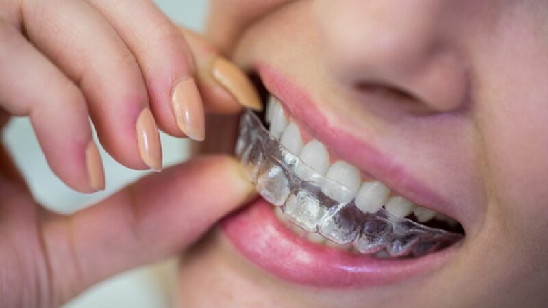 Improving dental health with Invisalign London