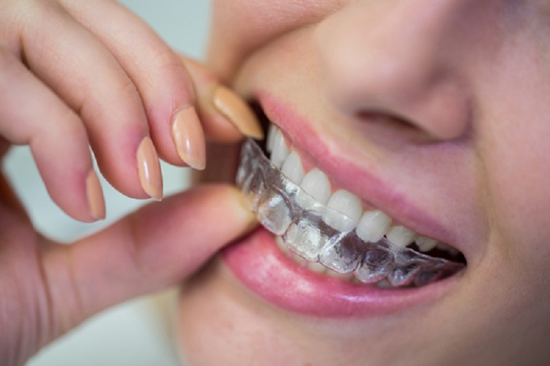 Improving dental health with Invisalign London
