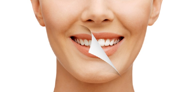 Cosmetic dental treatment with veneers
