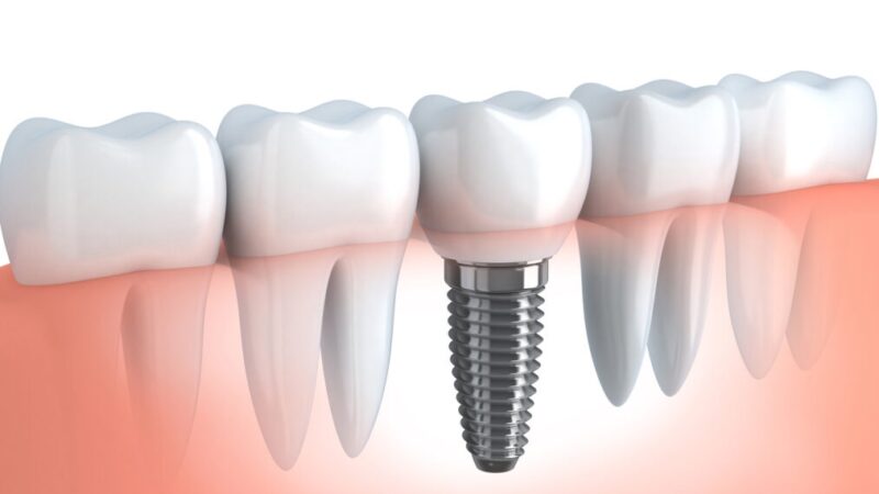 Combat tooth loss with dental implants Sydney