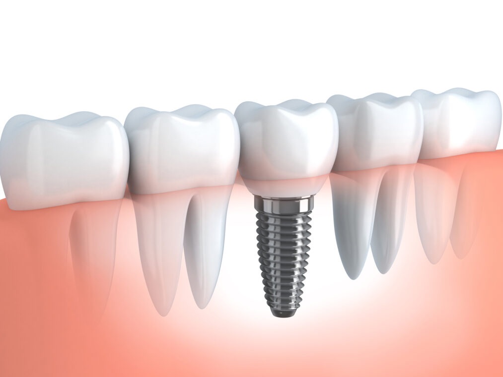 Combat tooth loss with dental implants Sydney