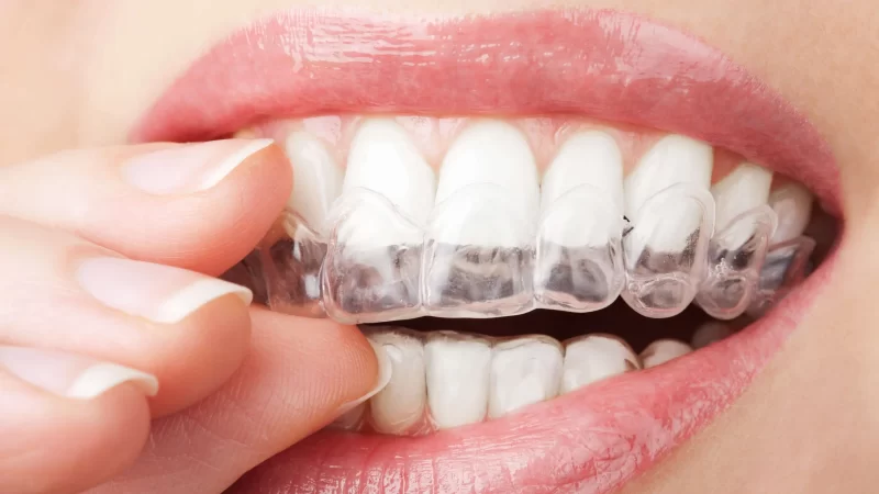 Important Information Regarding Invisalign