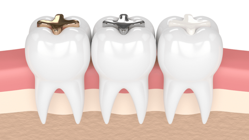 Understanding Different Types of Dental Fillings