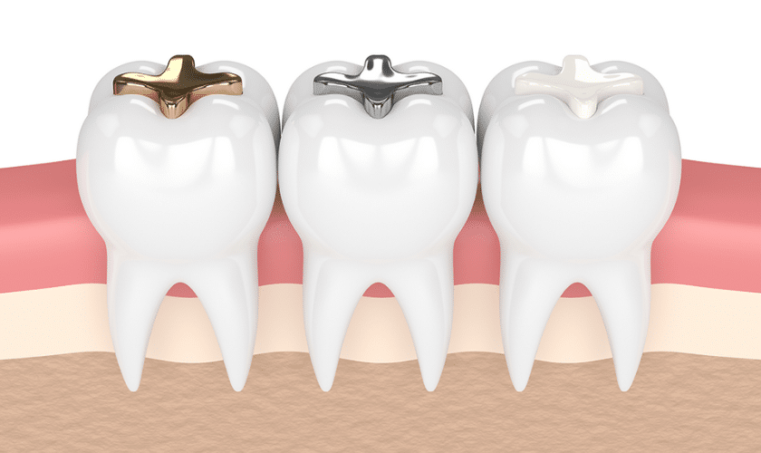 Understanding Different Types of Dental Fillings
