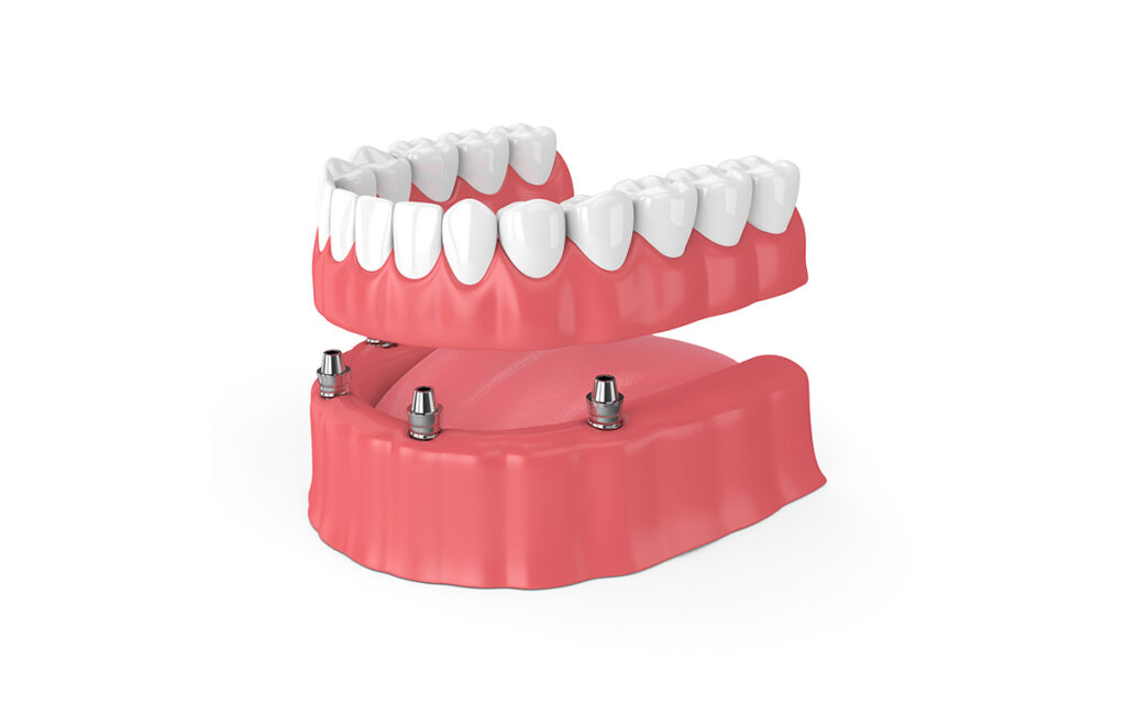 Why Choose Implant Dentures in Knoxville