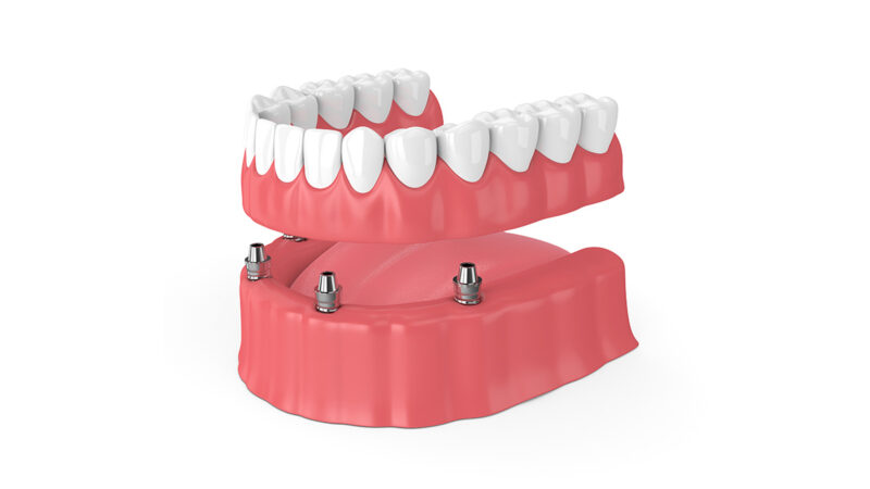 Embrace Stability and Comfort: The Advantages of Implant-Supported Dentures in Knoxville