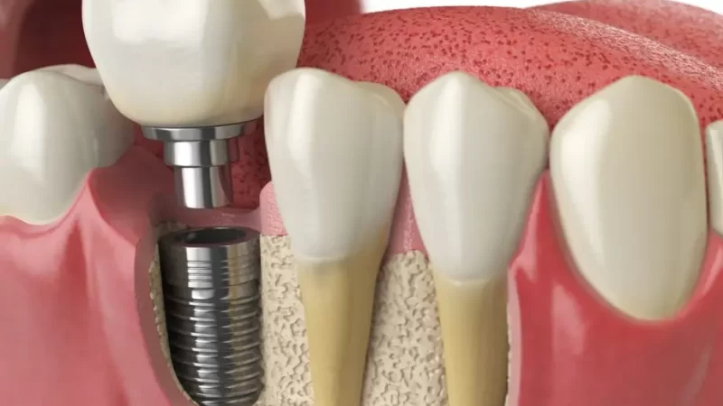Are Dental Implants Better Than Dentures?