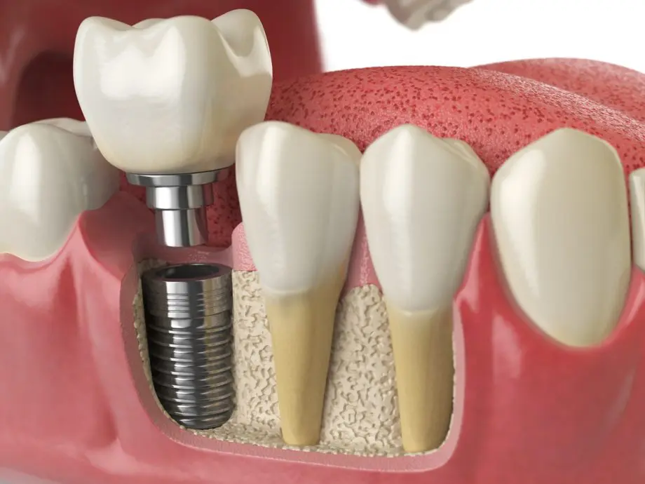 Are Dental Implants Better Than Dentures?