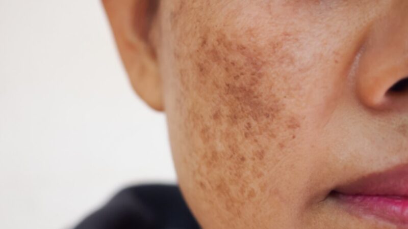 Banish Melasma with Innovative Melasma Treatment Options