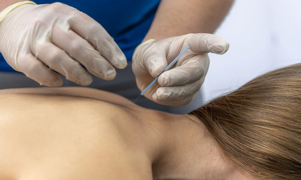 4 Benefits of Acupuncture for Menopause Symptoms